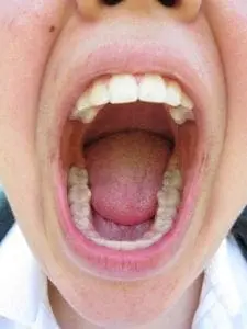 Child's open mouth with tongue visible, ready to say "aah".