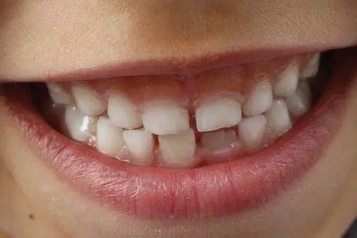 Close-up of a child's mouth showing uneven teeth and a gap.