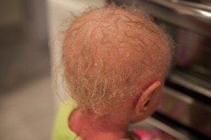 Baby's head with sparse, curly blond hair and visible dry skin patches.