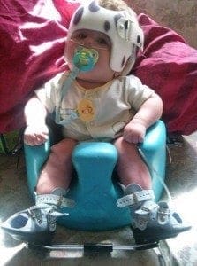 Baby Noel sits in a blue seat wearing a cranial helmet and leg braces.